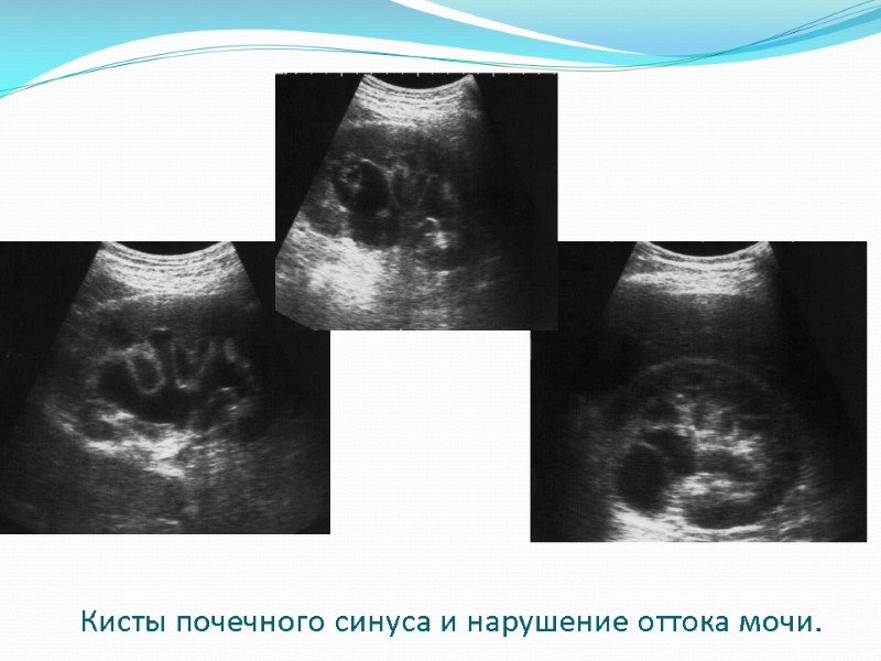 Кисты почечного синуса и нарушение оттока мочи.